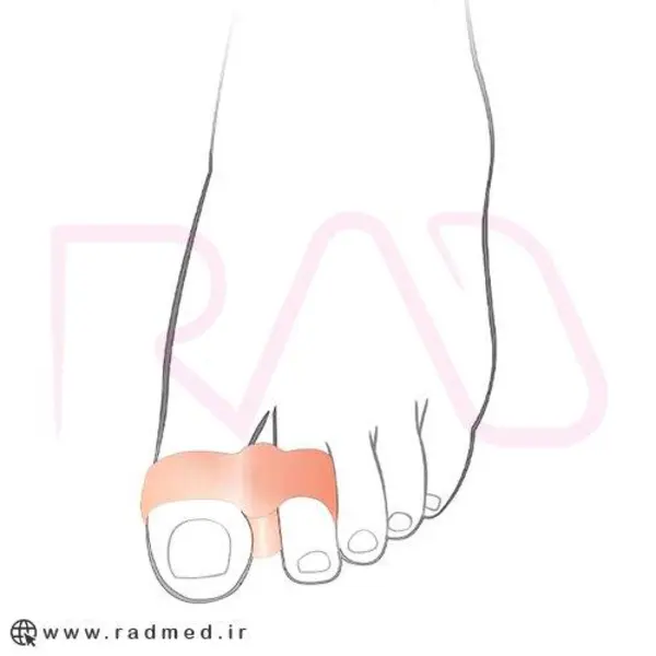 پد فاصله دهنده انگشت پا اوتسی کد TF 05 - 3